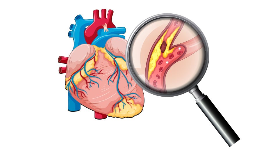 Coronary Heart Disease Analysis